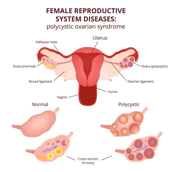 Understanding PCOS