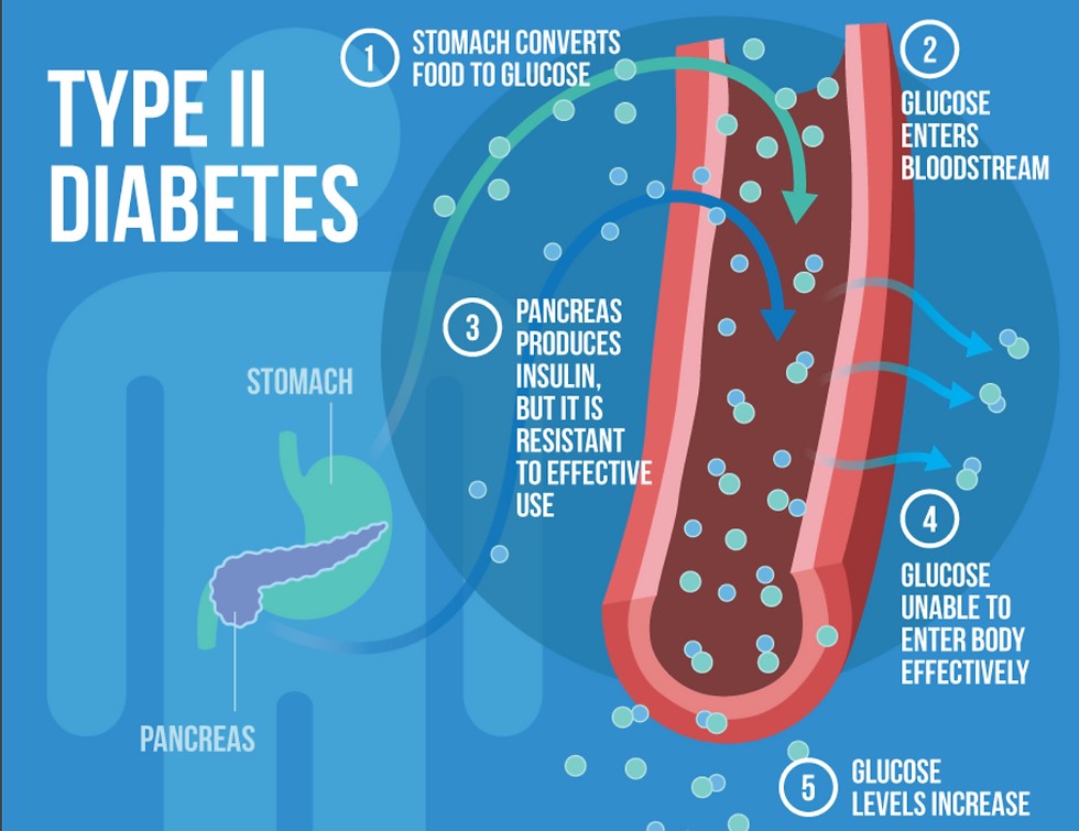 Finding the Best Type 2 Diabetes Treatment: A Comprehensive Guide